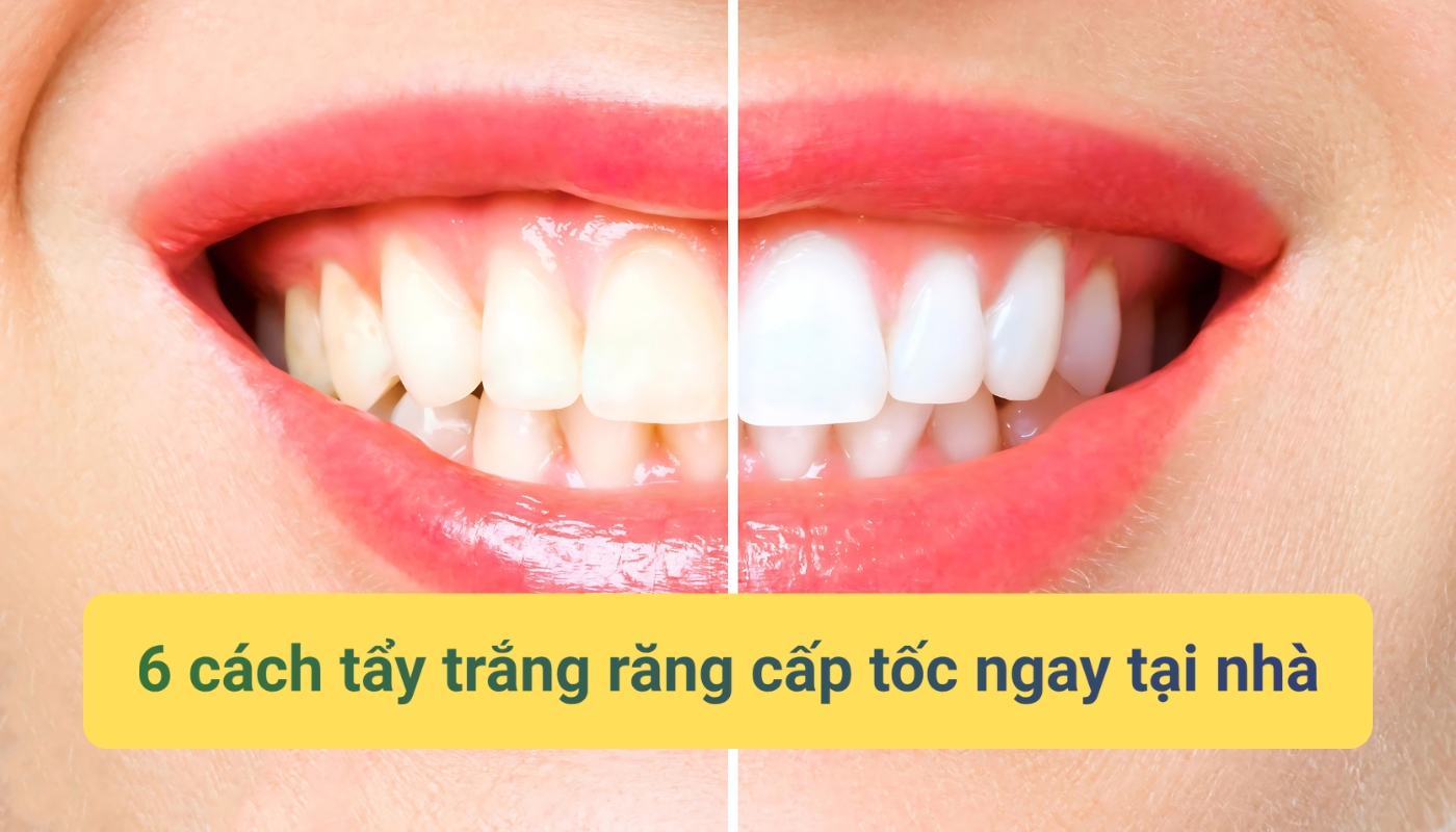 6 cách tẩy trắng răng cấp tốc ngay tại nhà