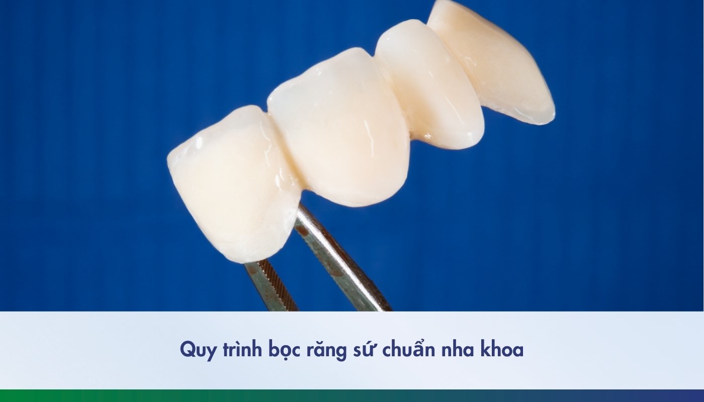 Quy trình bọc răng sứ chuẩn: Làm răng sứ đúng như thế nào?