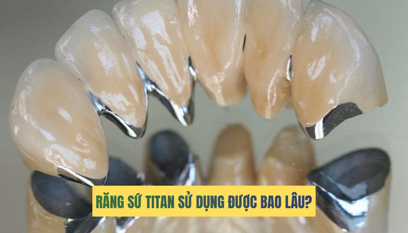 Răng sứ titan sử dụng được bao lâu? Ưu và nhược điểm