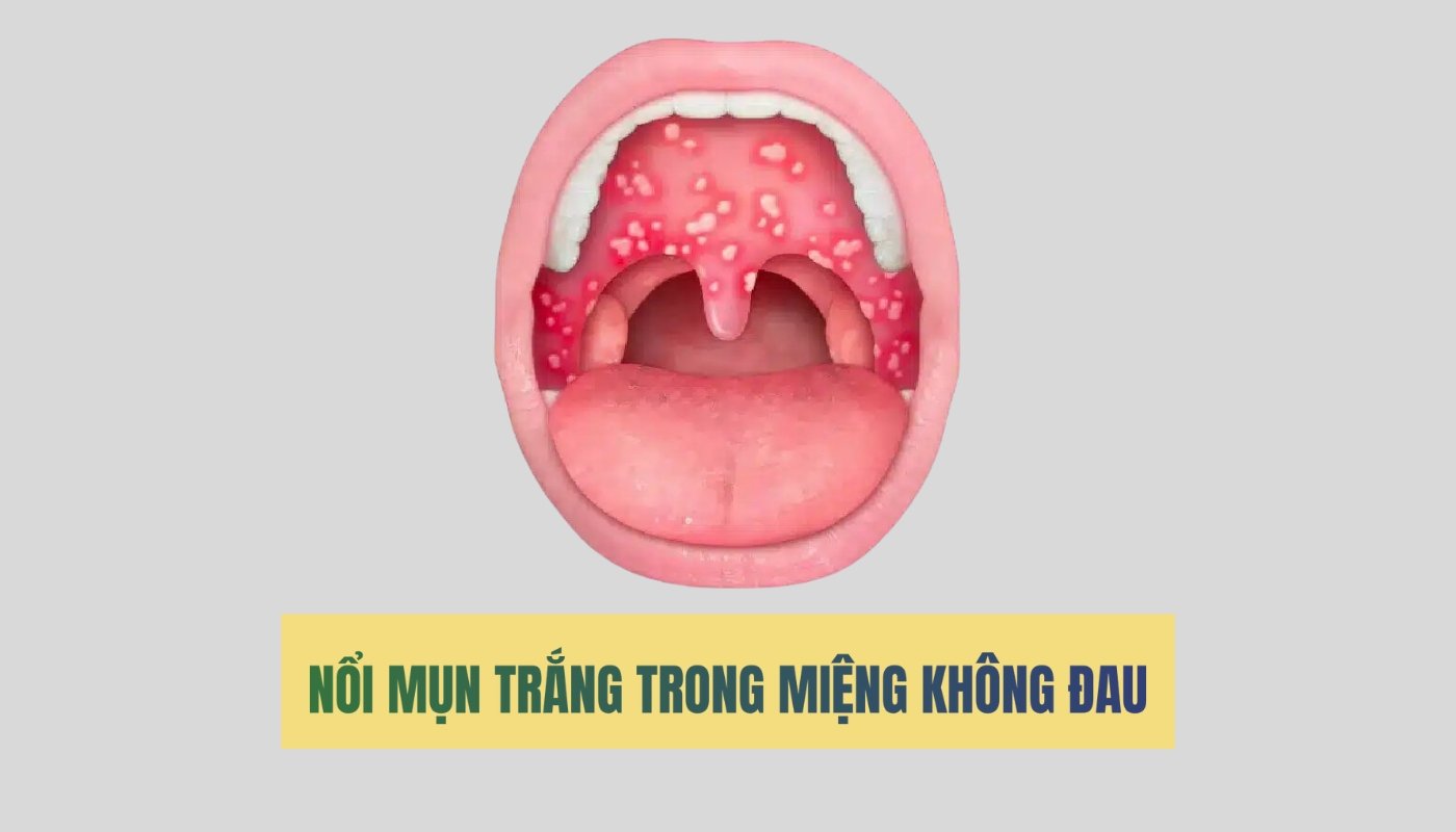 Nổi mụn trắng trong miệng không sao có sao không?