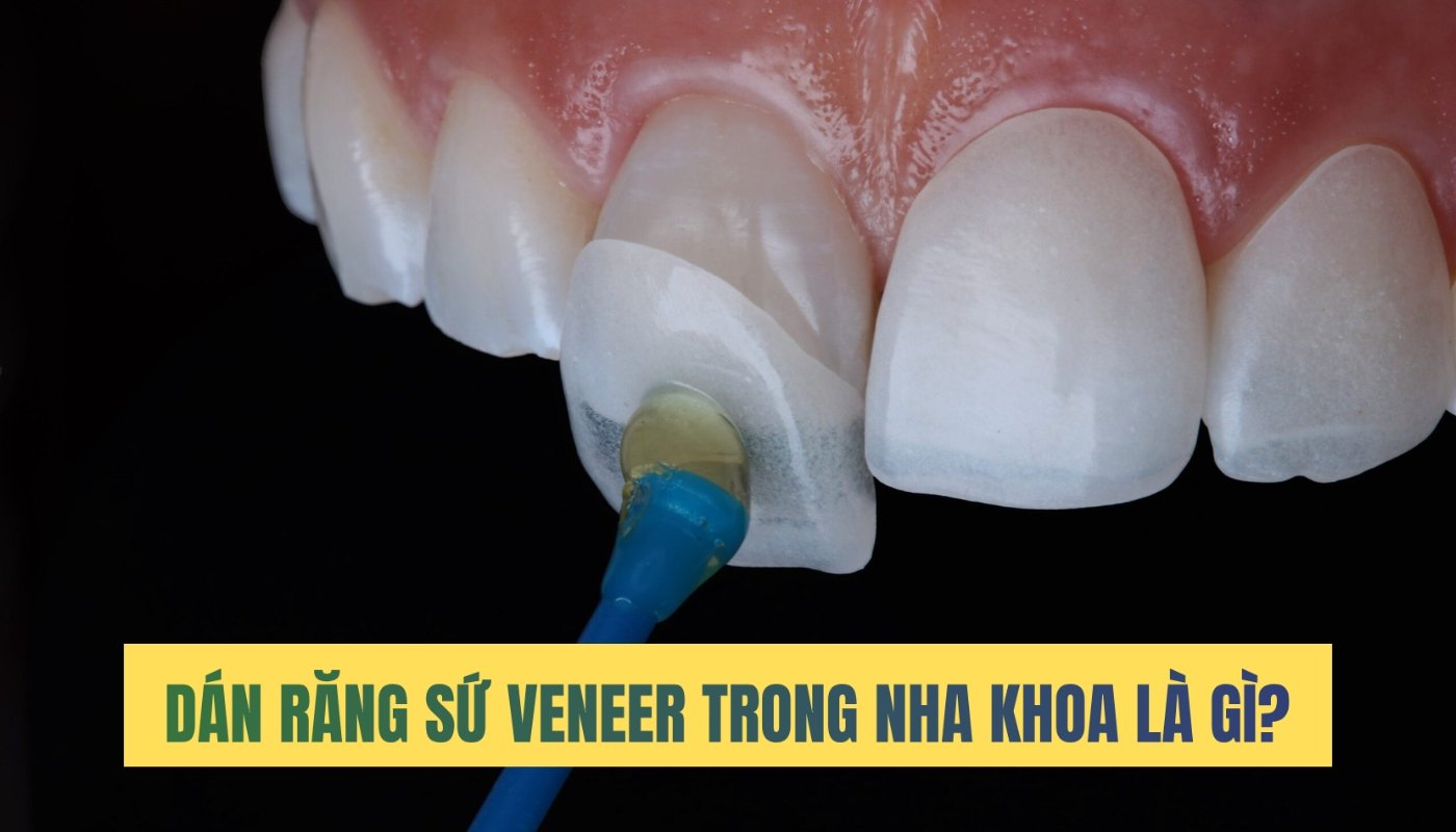 Dán răng sứ veneer