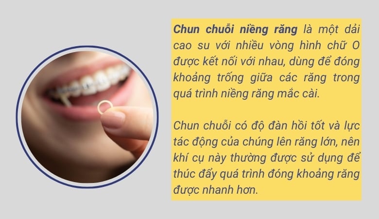 Chun chuỗi niềng răng - 2