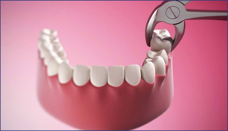Nhổ răng khôn là gì