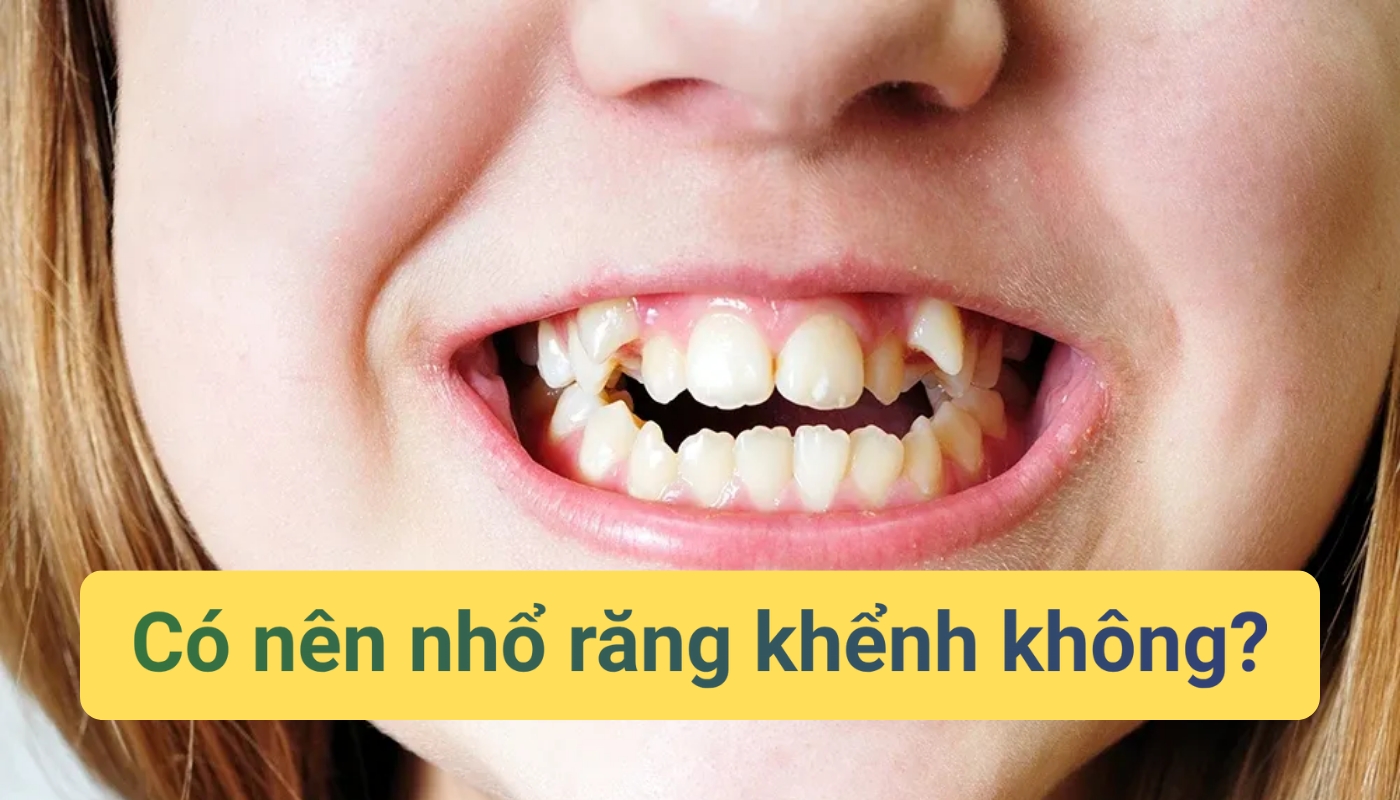 Có nên nhổ răng khểnh không