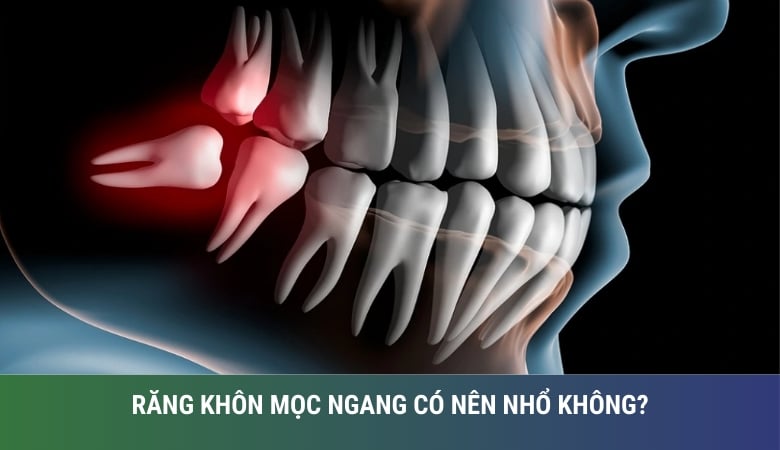 răng khôn mọc ngang có nên nhổ không