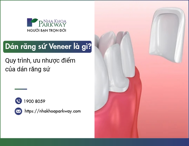 Dán răng sứ Veneer là gì? Quy trình, ưu nhược điểm của dán răng sứ