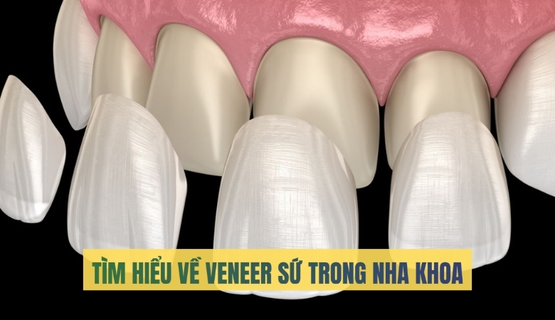 Dán răng sứ veneer trong nha khoa - 1