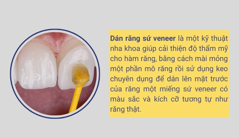 Dán răng sứ veneer trong nha khoa - 2