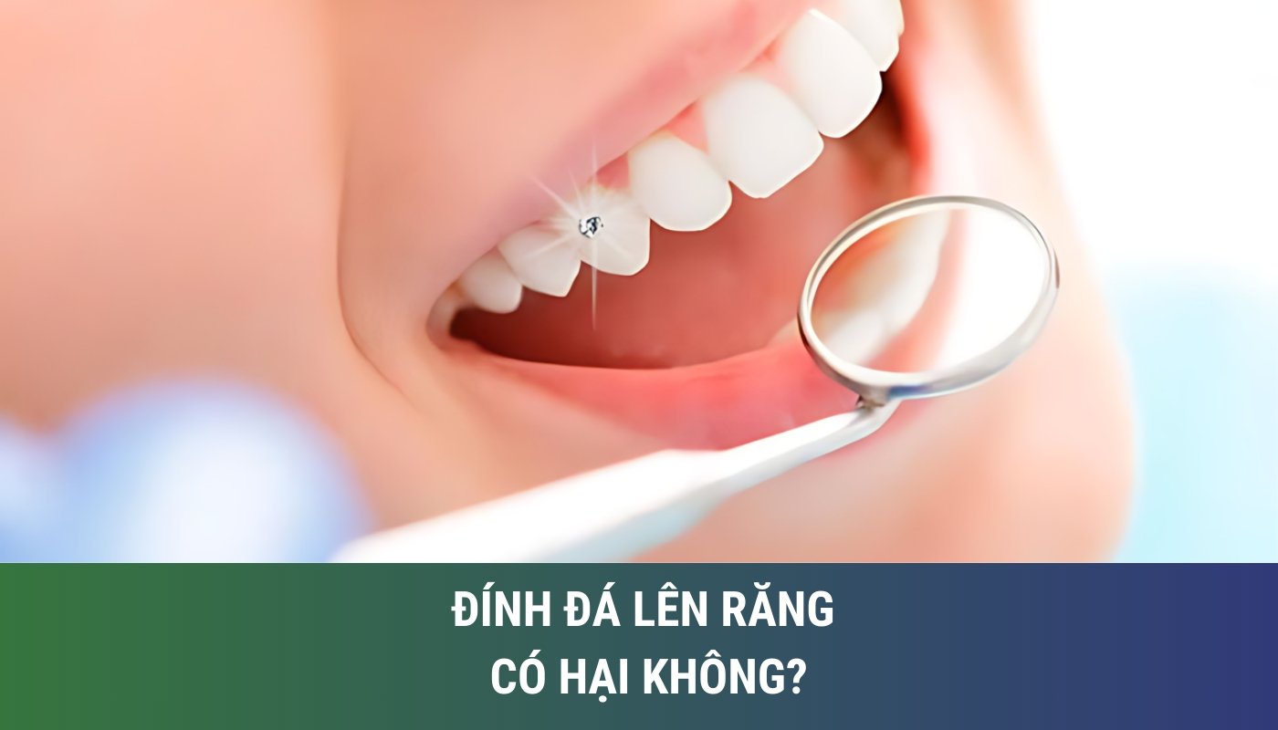 đính đá lên răng có hại không