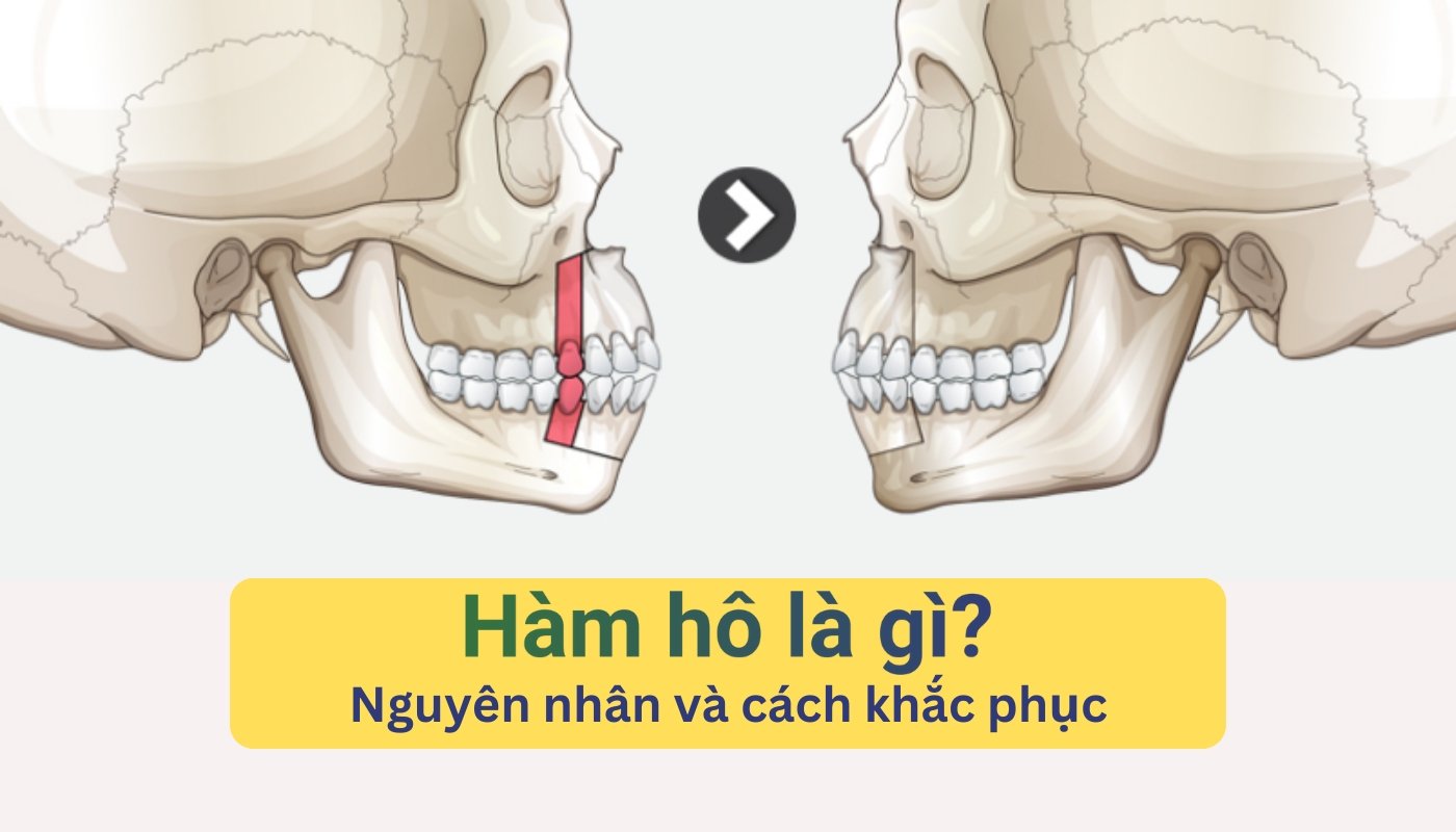 hàm hô là gì? Nguyên nhân và cách khắc phục hàm hô