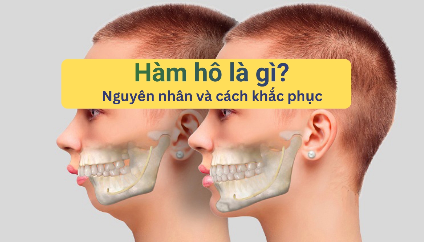 Hàm hô là gì? Nguyên nhân và cách khắc phục