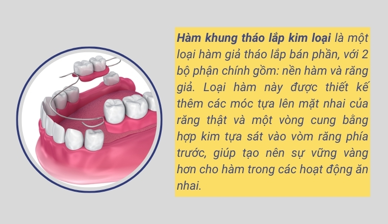 Hàm khung tháo lắp kim loại - 2