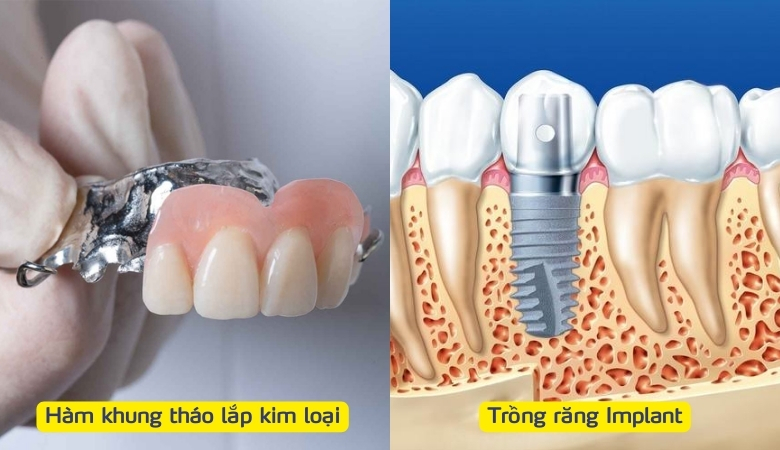 Hàm khung tháo lắp kim loại - 5