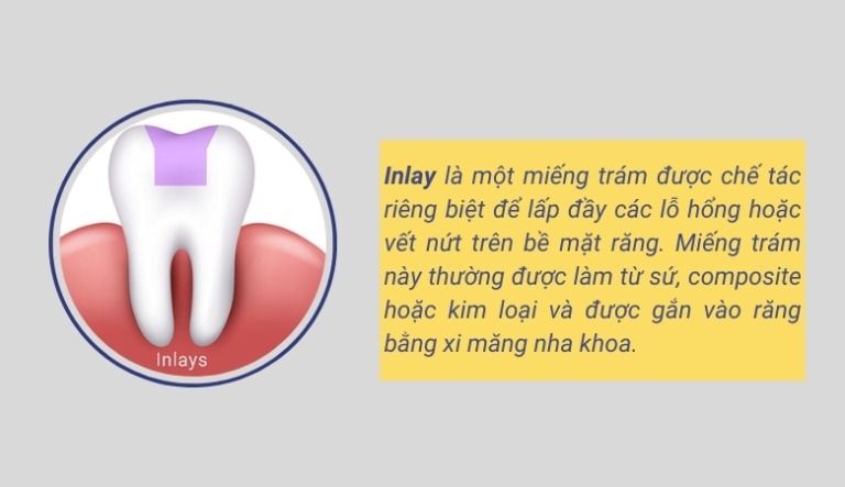 Inlay, Onlay là gì? Ưu nhược điểm của trám răng Inlay/Onlay