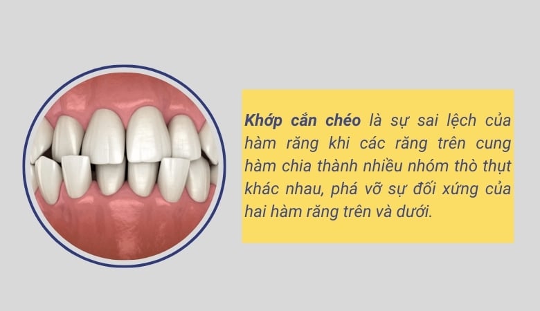 Khớp cắn chéo - 2