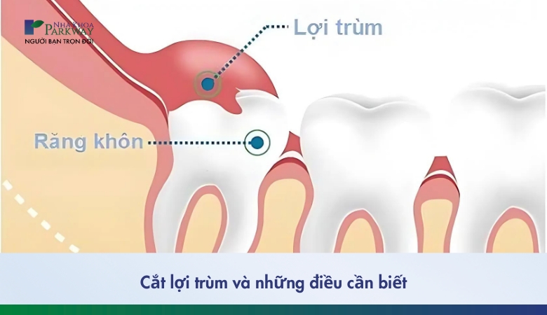 Cắt lợi trùm và những những điều bạn cần biết