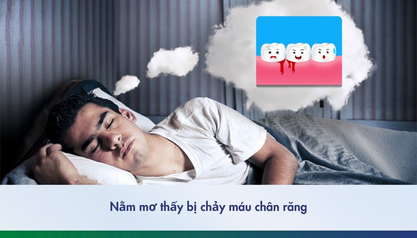 Mơ chảy máu chân răng