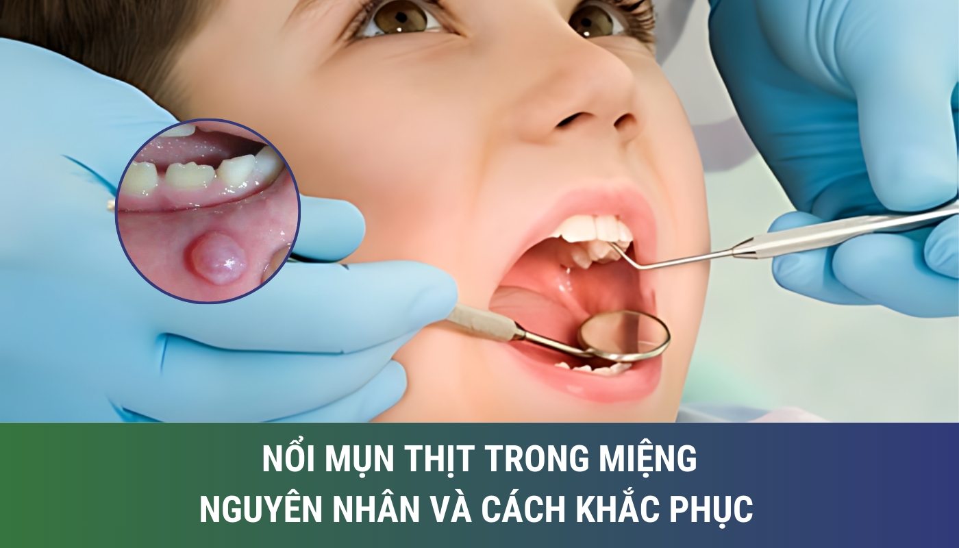 nổi m ụn thịt trong miệng có nguyên nhân gì