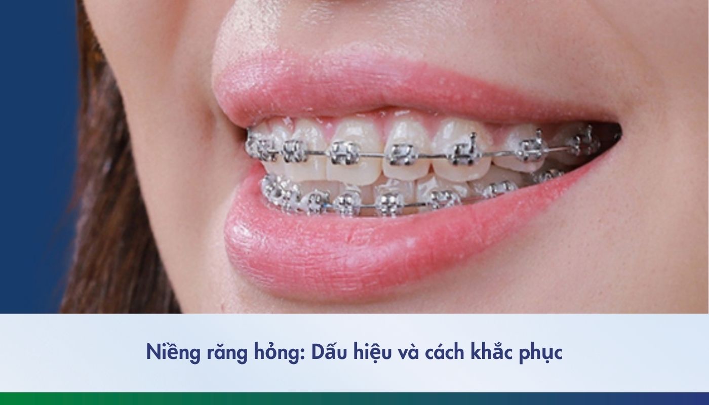 Dấu hiệu và cách khắc phục niềng răng hỏng
