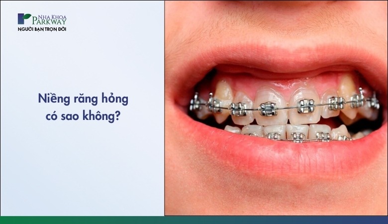 Dấu hiệu nhận biết niềng răng hỏng