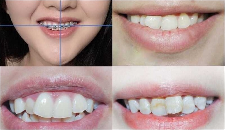 Niềng răng hỏng gây lệch mặt