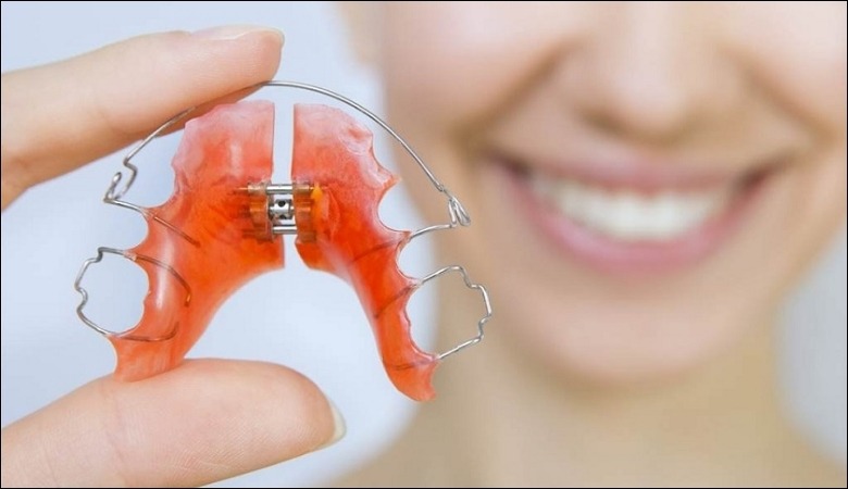 Sử dụng hàm duy trì sai cách khiến kết quả niềng răng không được duy trì