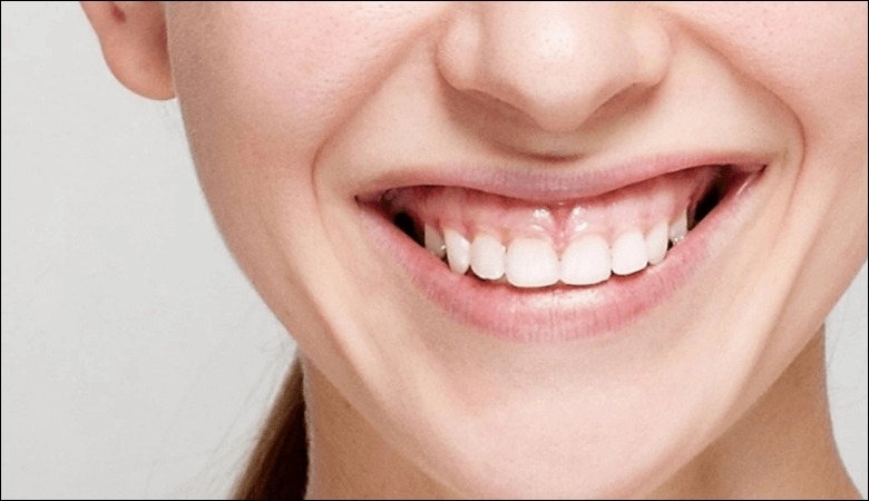 Niềng răng hỏng khiến cười hở lợi nặng hơn