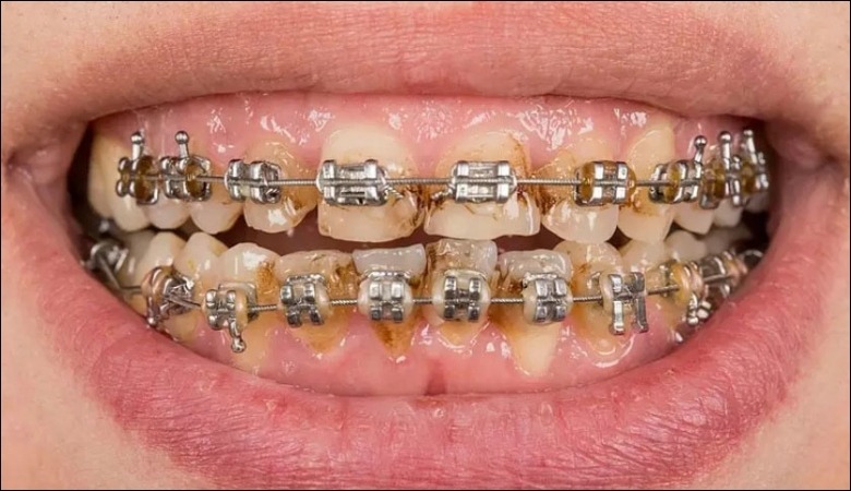 Tụt lợi sau khi niềng răng bị hỏng