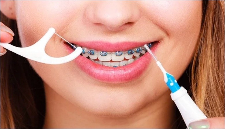 Chăm sóc răng niềng không đúng cách có thể làm hỏng cả quá trình chỉnh nha