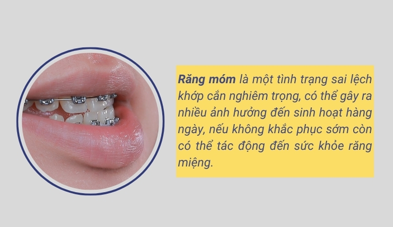 Niềng răng móm - 2