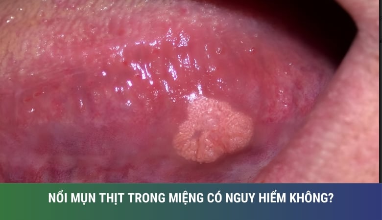 Hình ảnh nổi mụn thịt ở lưỡi 