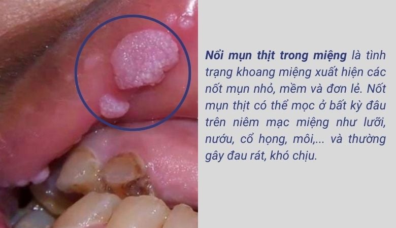 Mụn thịt trong miệng là tình trạng khoang miệng xuất hiện các nốt mụn nhỏ, mềm và đơn lẻ