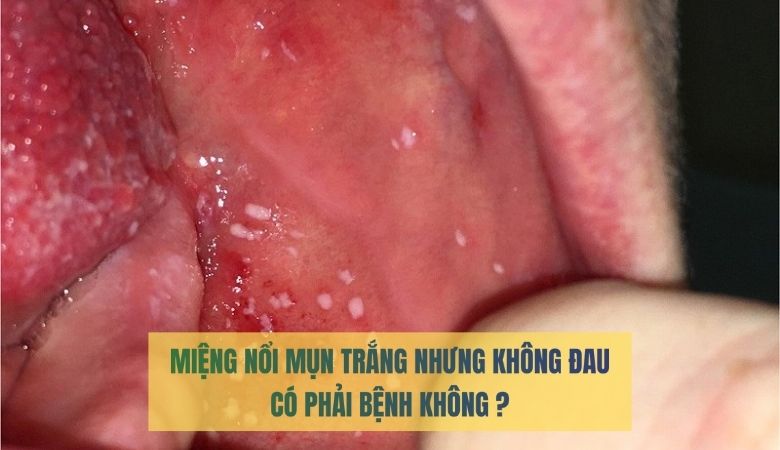 Nổi mụn trắng trong miệng không đau có phải là bệnh không?