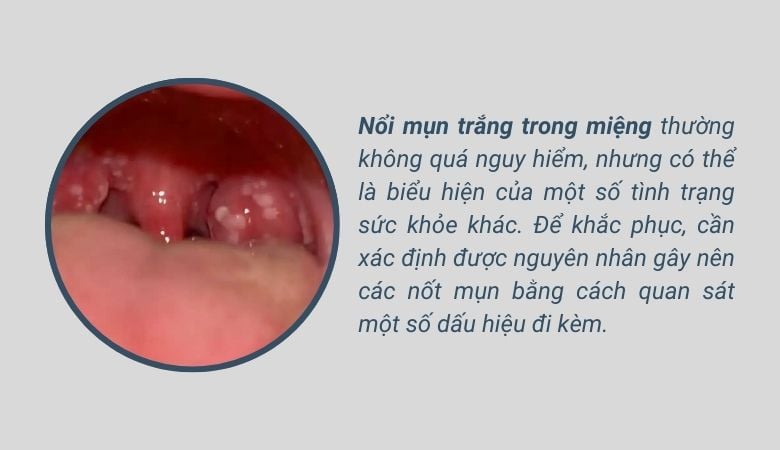 Nổi mụn trắng trong miệng không đau có thể là tình trạng mới khởi phát của các nốt mụn