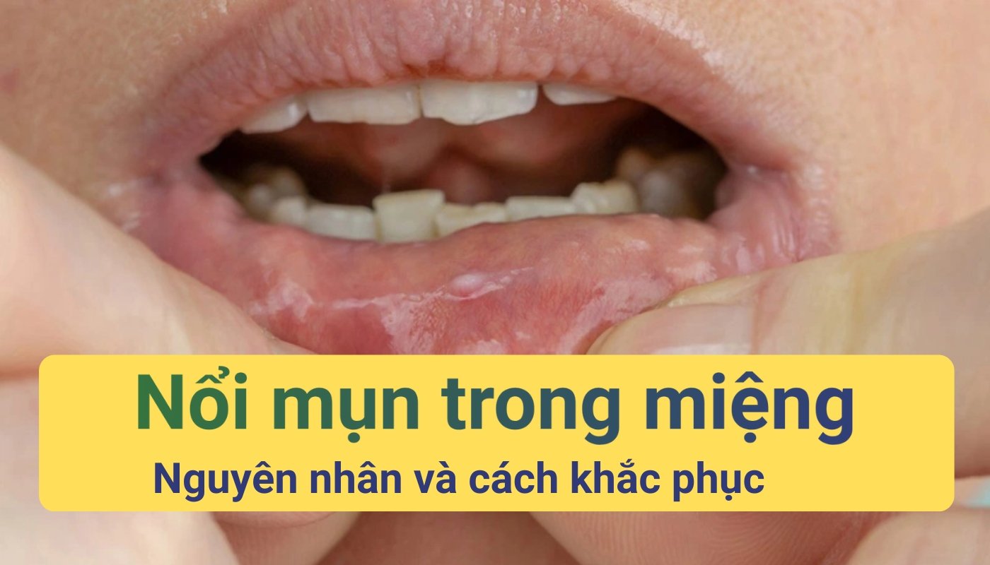 Hình ảnh nnổi mụn trong miệng