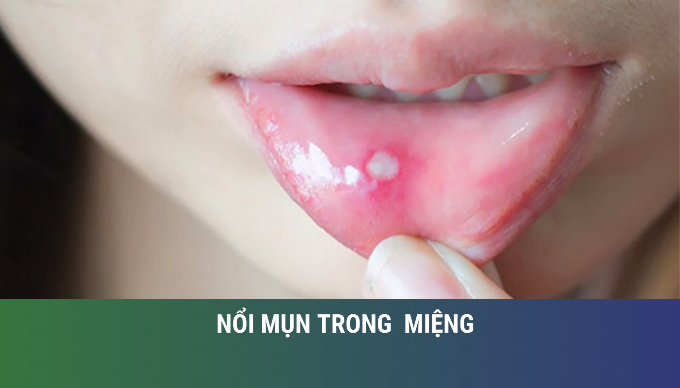 nổi mụn trong miệng