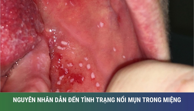 hình ảnh nổi mụn trong miệng