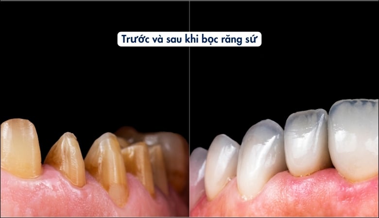 Quy trình bọc răng sứ chuẩn nha khoa - 3