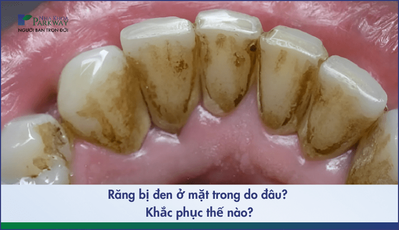 Răng bị đen ở mặt trong