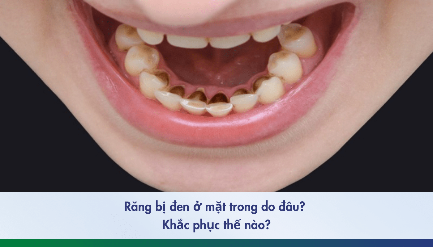 Răng bị đen ở mặt trong do dâu - 1