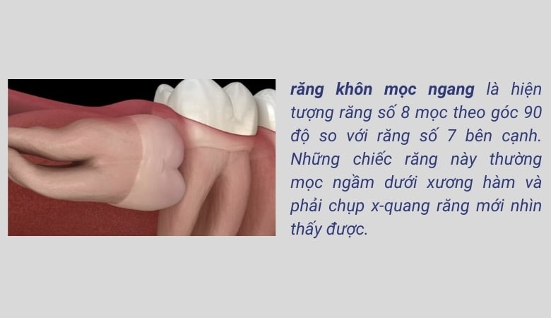 Răng khôn mọc ngang là hiện tượng răng số 8 mọc theo góc 90 độ so với răng số 7