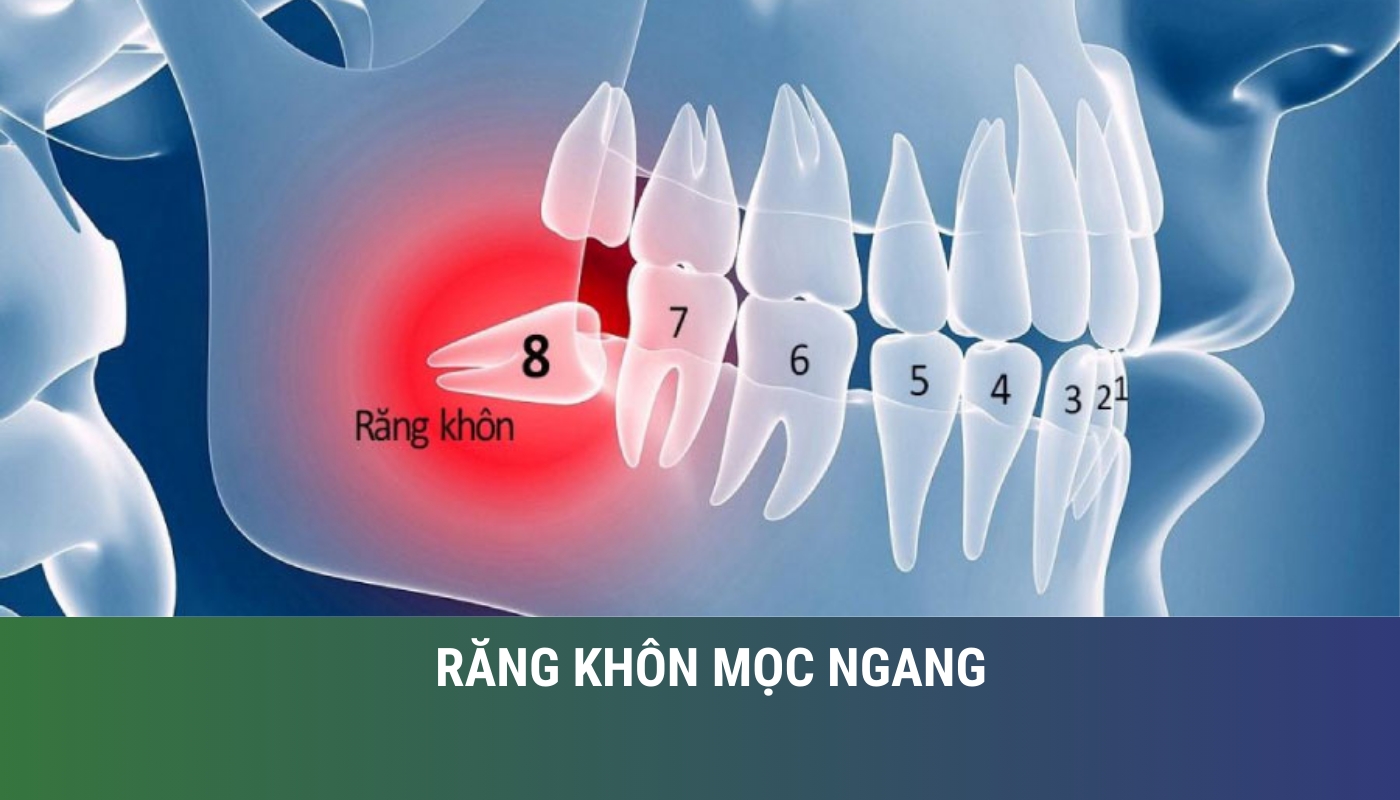 răng khôn mọc ngang