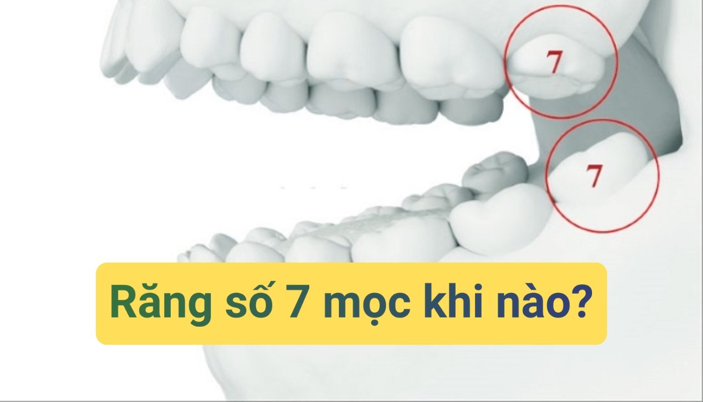 Răng số 7 mọc khi nào