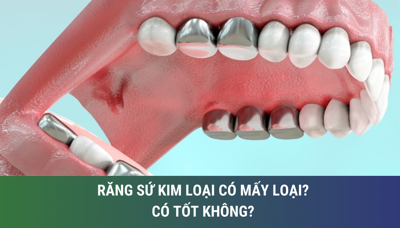 Răng sứ kim loại có mấy loại