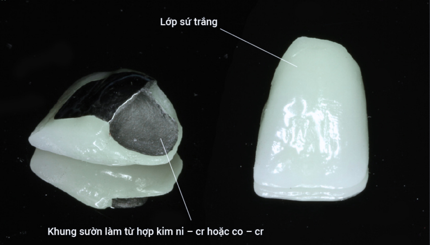 Hình ảnh răng sứ kim loại thường