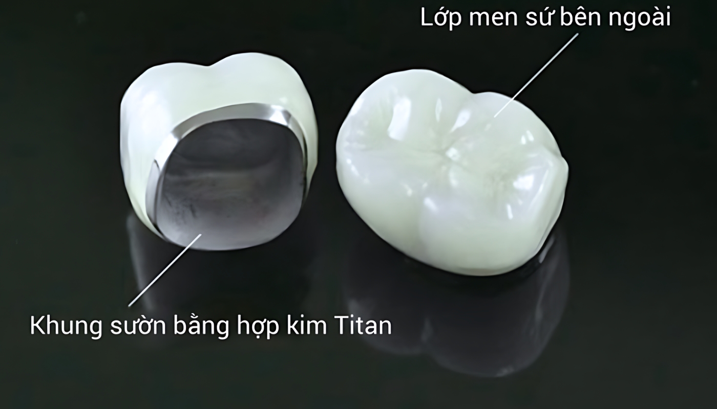 Hình ảnh răng sứ kim loại titan