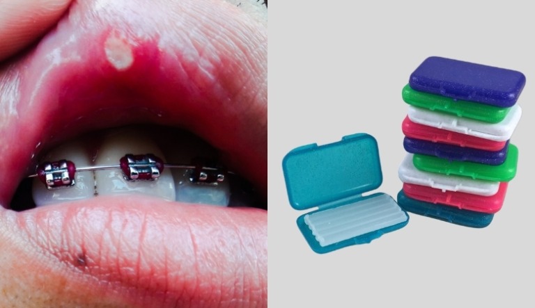 Sáp nha khoa là gì? Sử dụng thế nào? Top 5 loại sáp phổ biến