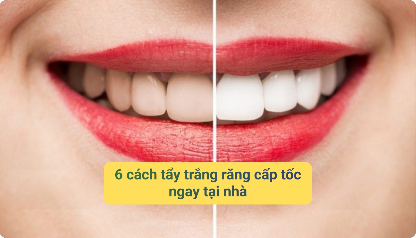 6 cách tẩy trắng răng cấp tốc ngay tại nhà