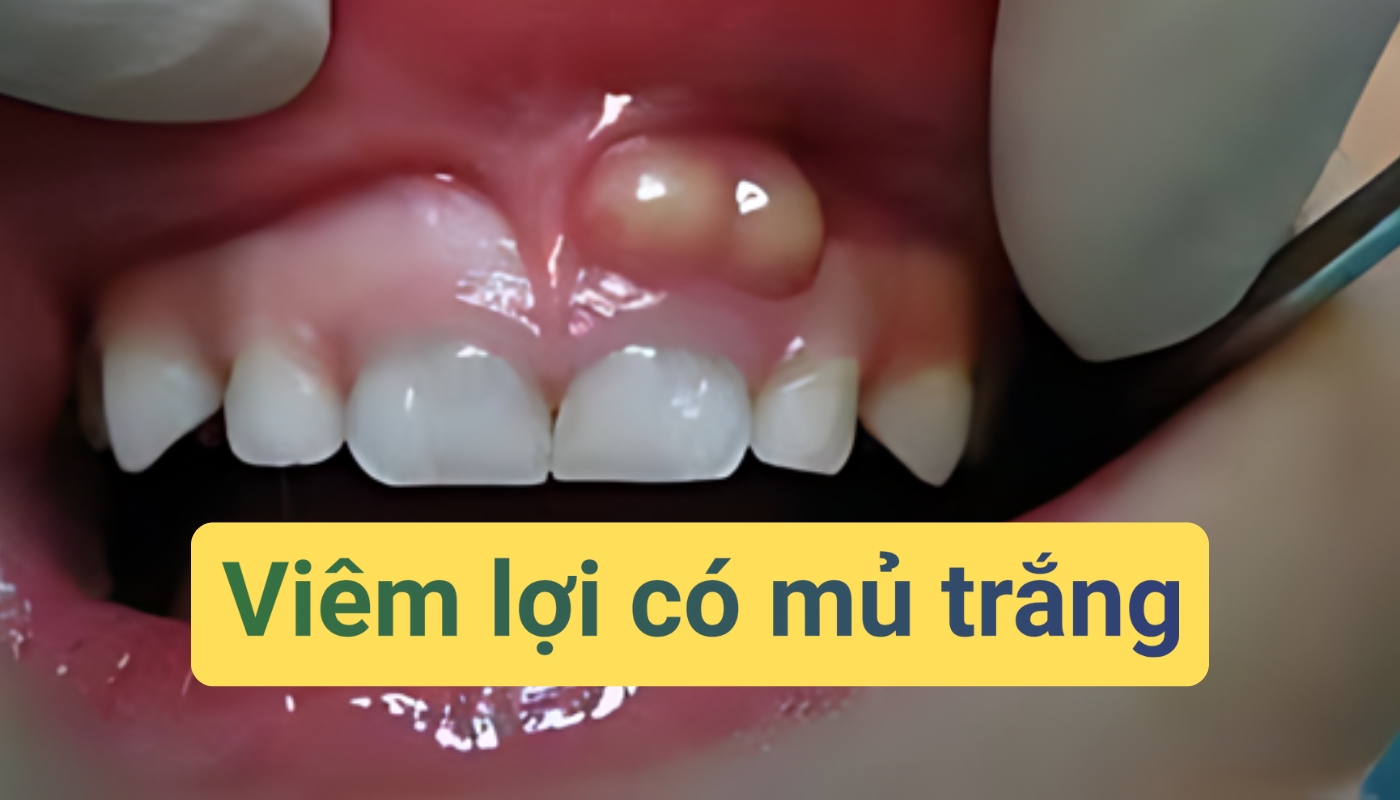 Viêm lợi có mủ trắng là tình trạng gì