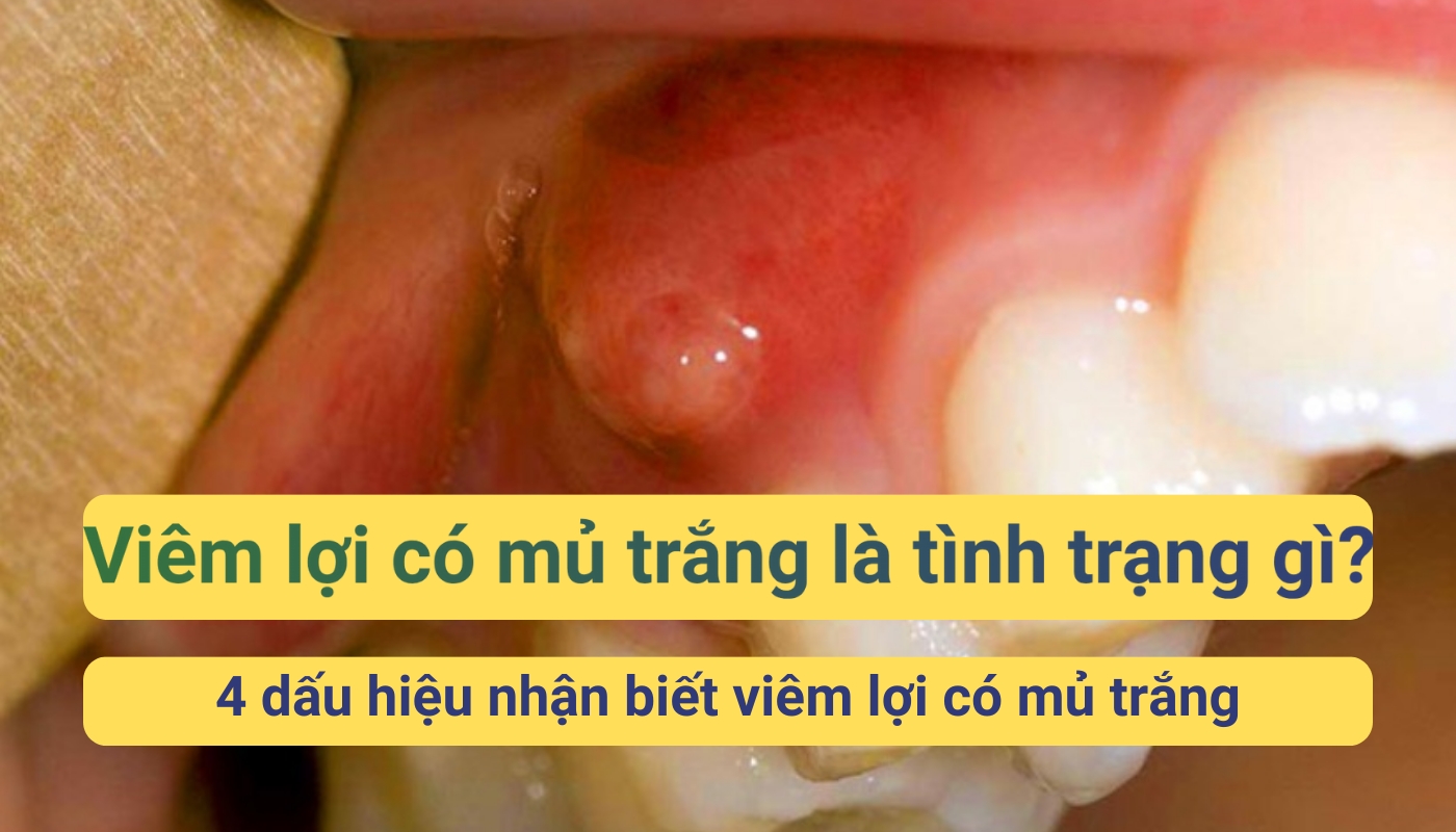 Viêm lợi có mủ trắng là tình trạng gì